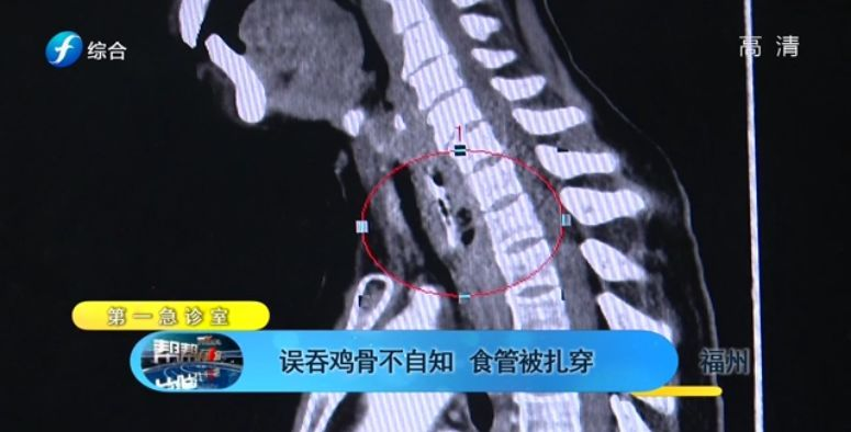 惊险一幕，男子吃饭狼吞虎咽不慎把食管吃破了！紧急救治背后的故事